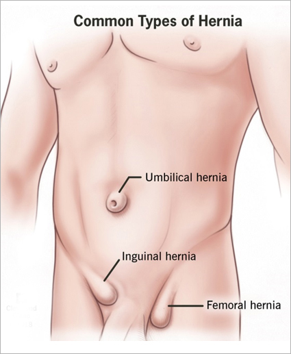 Herania Repair